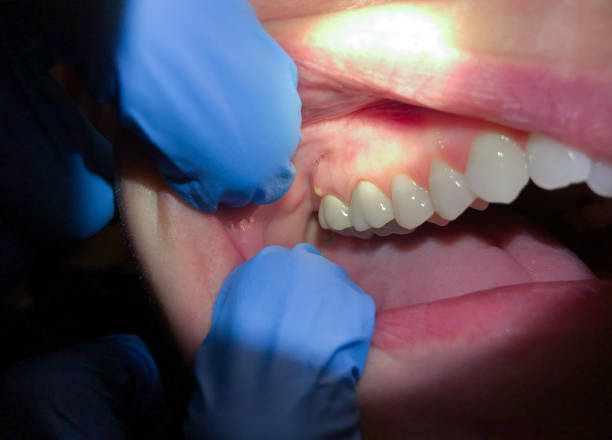 Best Emergency Denture Repair in Little Cypress, TX