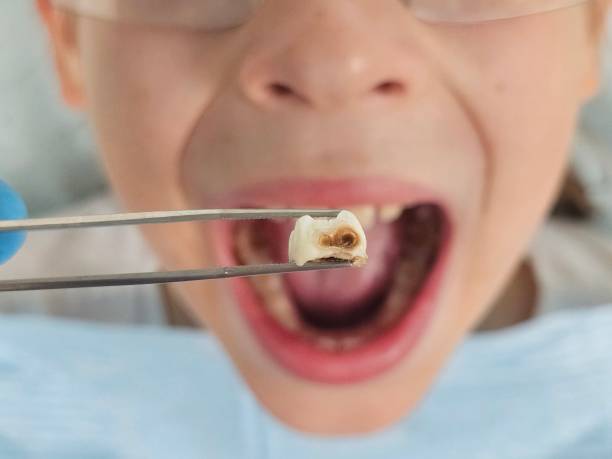 Best Emergency Wisdom Teeth Removal in Little Cypress, TX